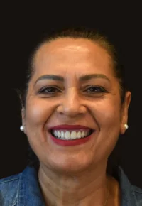 tratamiento de carillas dentales