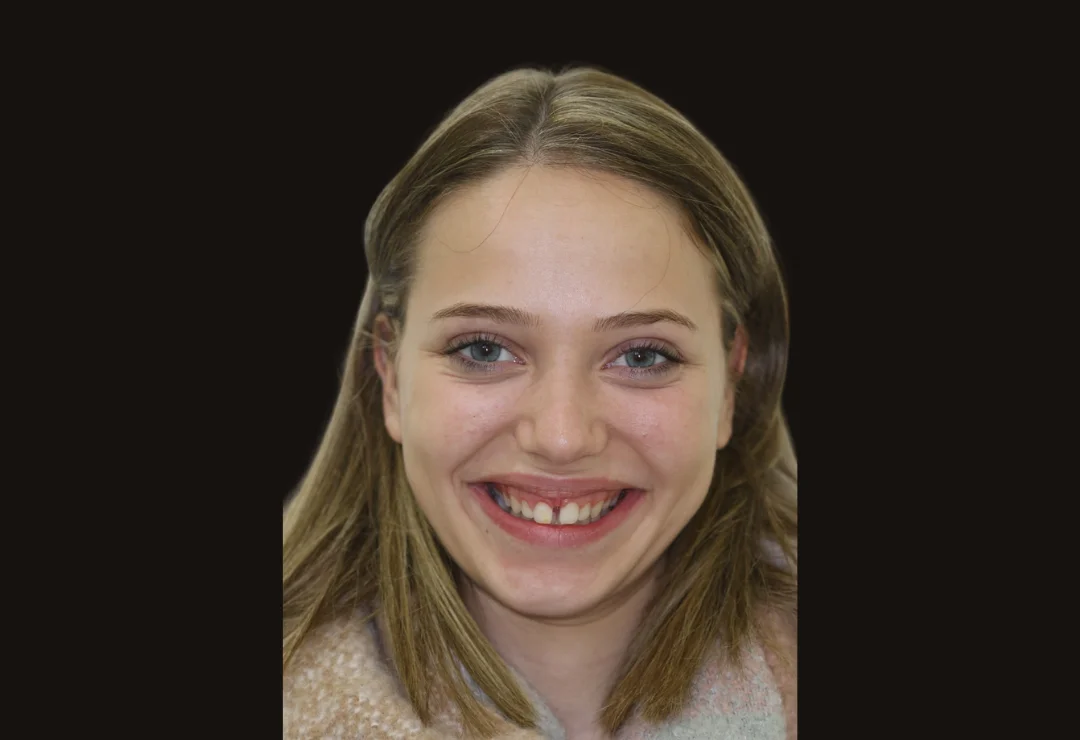 Carillas de Porcelana - Andrea 3 Carillas de Porcelana - Andrea 3