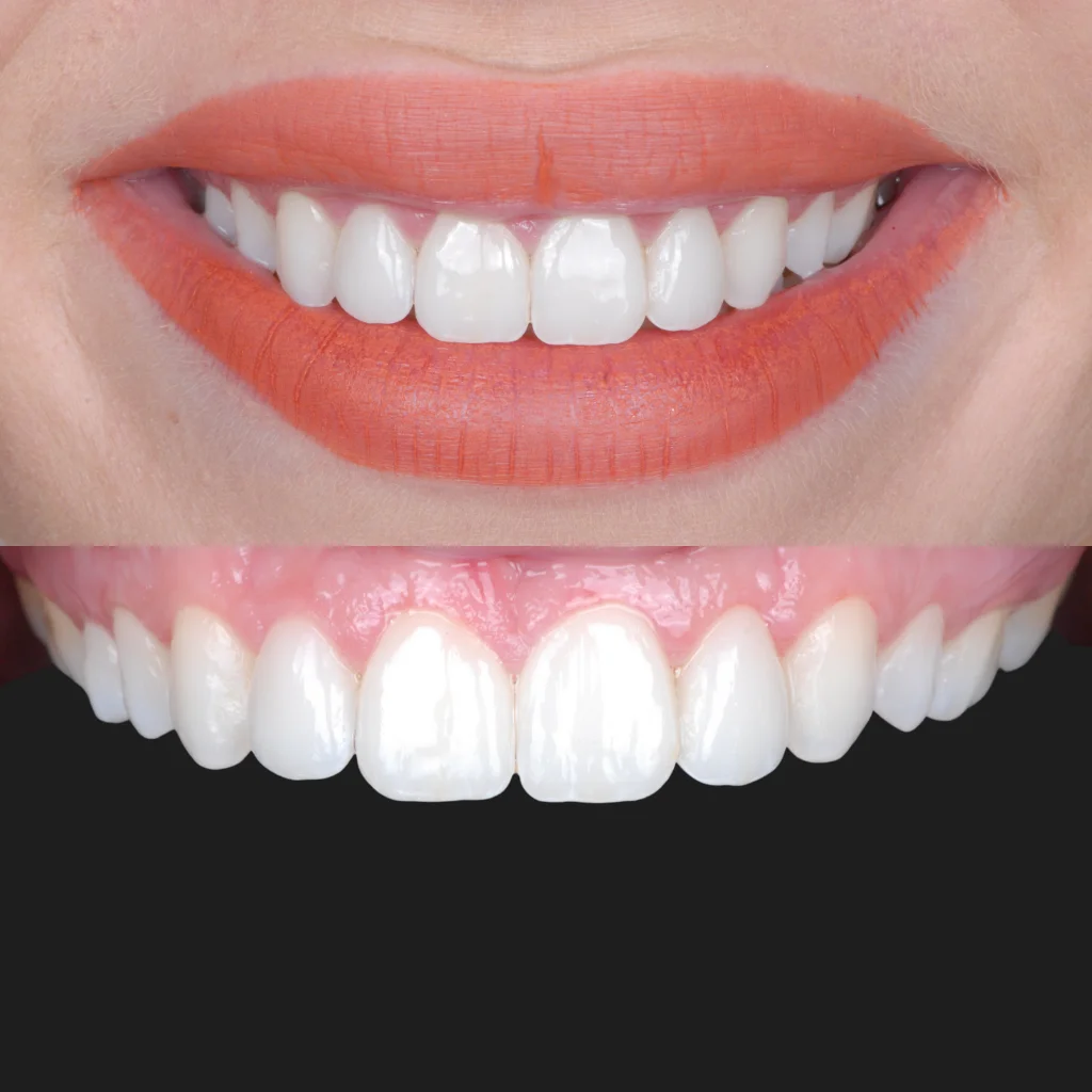 Carillas de Porcelana - Andrea 2 Carillas de Porcelana - Andrea 2