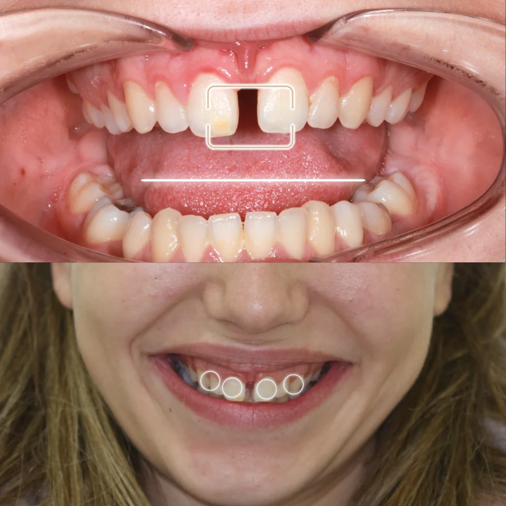 Carillas de Porcelana - Andrea 1 Carillas de Porcelana - Andrea 1