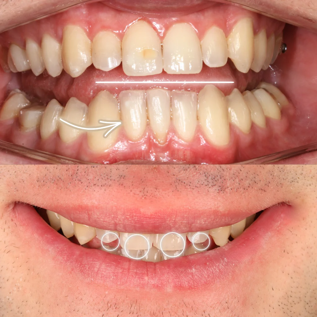 Carillas de Porcelana - Antonio 1 Carillas de Porcelana - Antonio 1