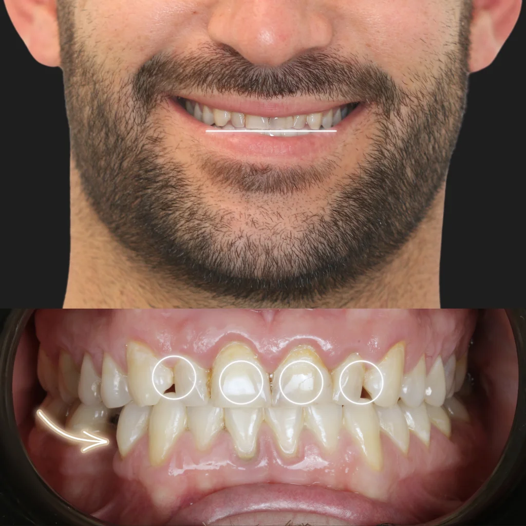 Carillas de Porcelana - Kevin 1 Carillas de Porcelana - Kevin 1