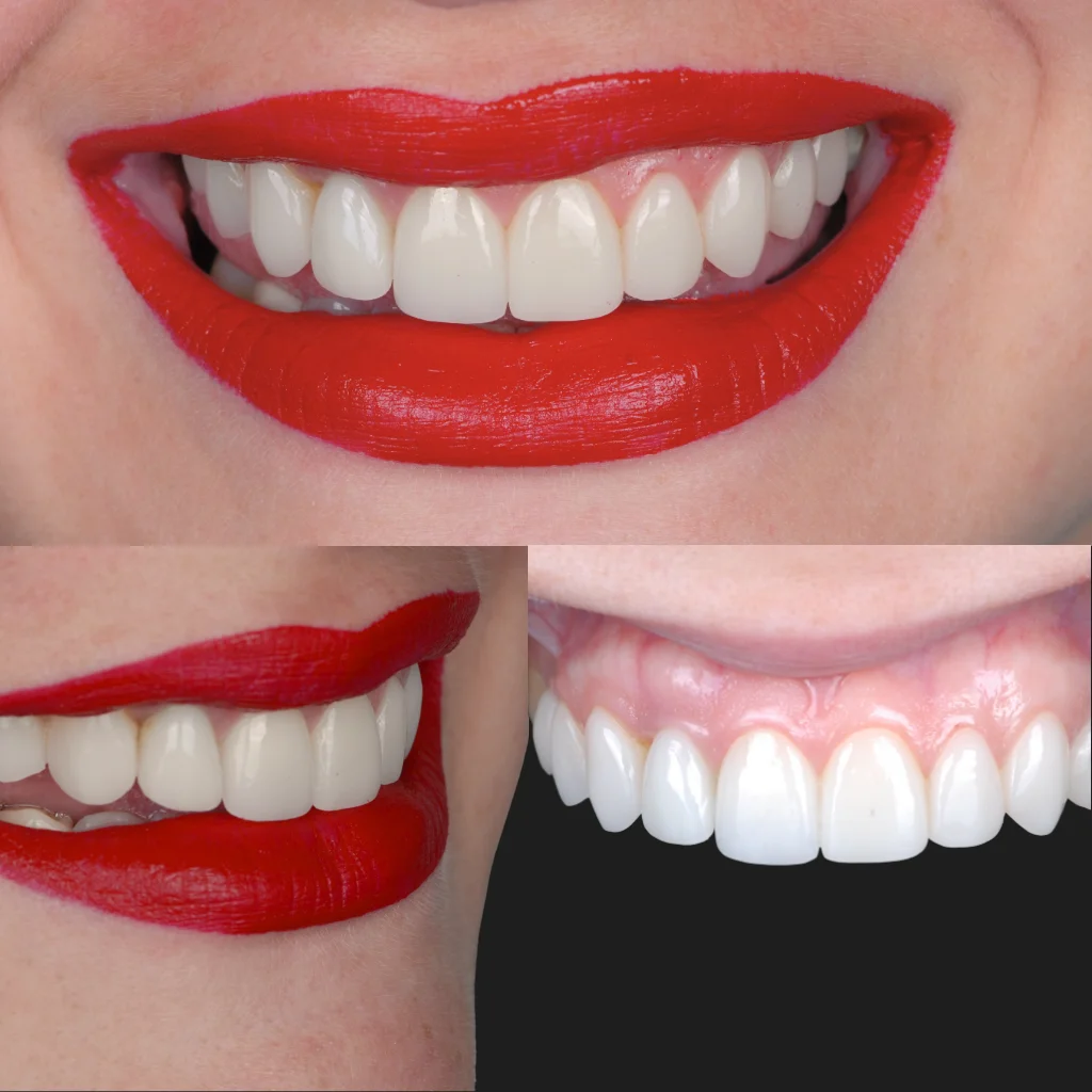 Carillas de Porcelana - Macarena 2 Carillas de Porcelana - Macarena 2