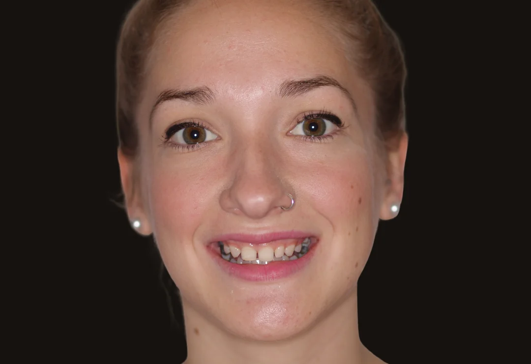 Carillas de Porcelana - Macarena 3 Carillas de Porcelana - Macarena 3