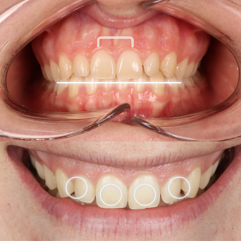 Carillas de Composite - Miriam 1 Carillas de Composite - Miriam 1