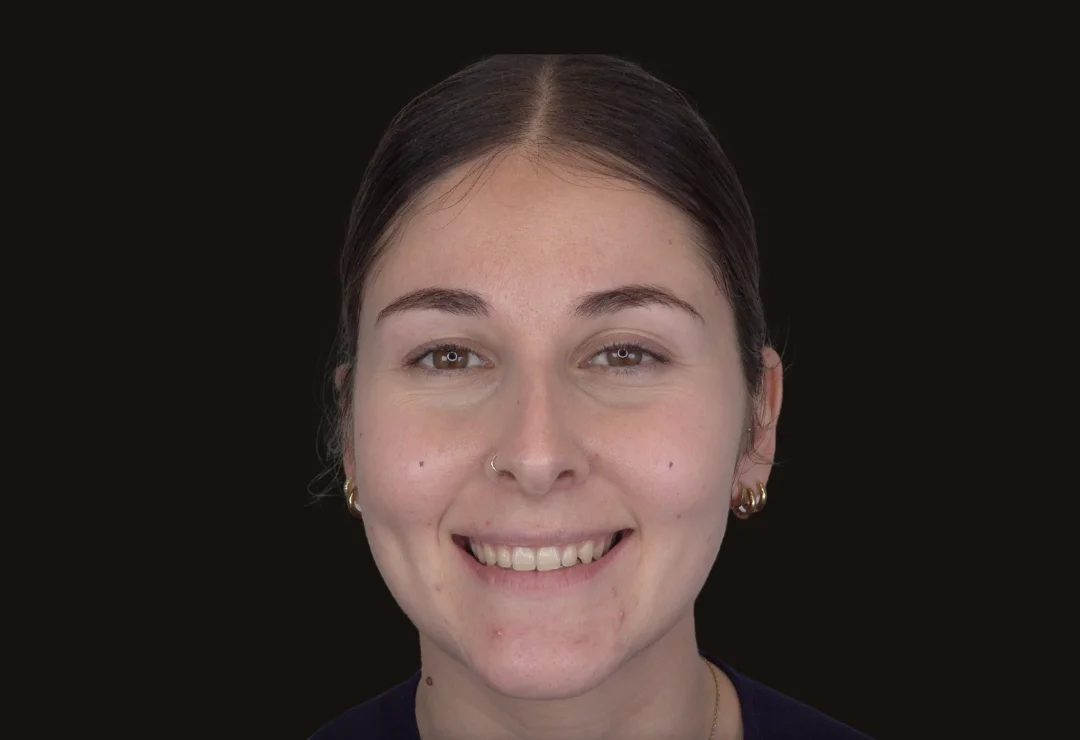 Carillas de Composite - Miriam 3 Carillas de Composite - Miriam 3