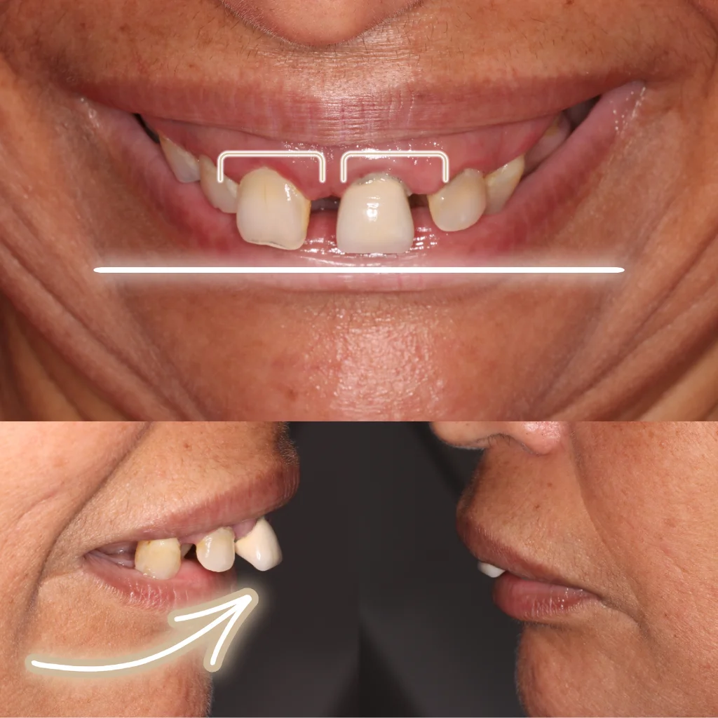 Implantes Dentales - Rabea 1 Implantes Dentales - Rabea 1