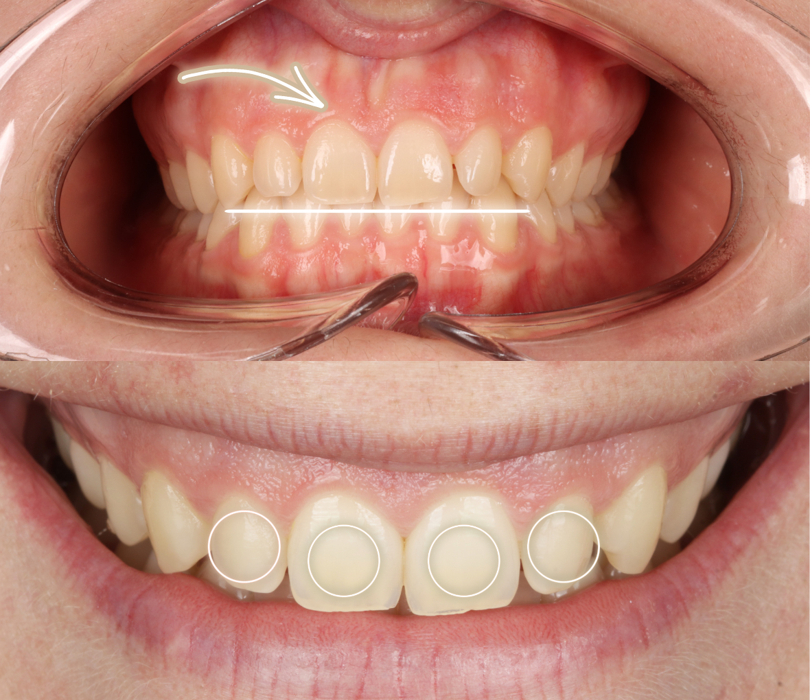 Implantes Dentales - Salud Reina 1