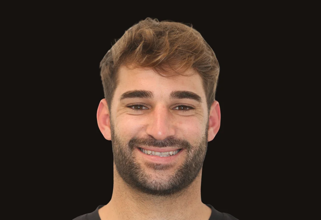 Carillas de Porcelana - Kevin 3 Carillas de Porcelana - Kevin 3