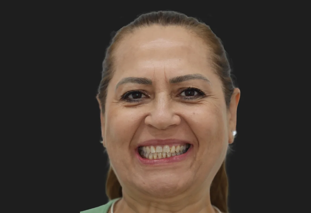 Carillas de Porcelana - Sonia 3 Carillas de Porcelana - Sonia 3