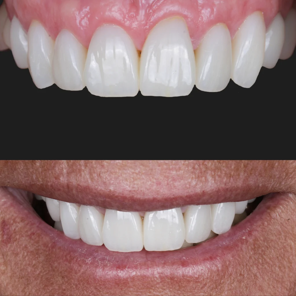 Carillas de Porcelana - Angelique 2 Carillas de Porcelana - Angelique 2