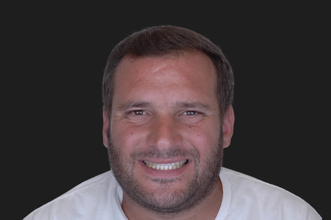 Carillas de Porcelana - José 3 Carillas de Porcelana - José 3