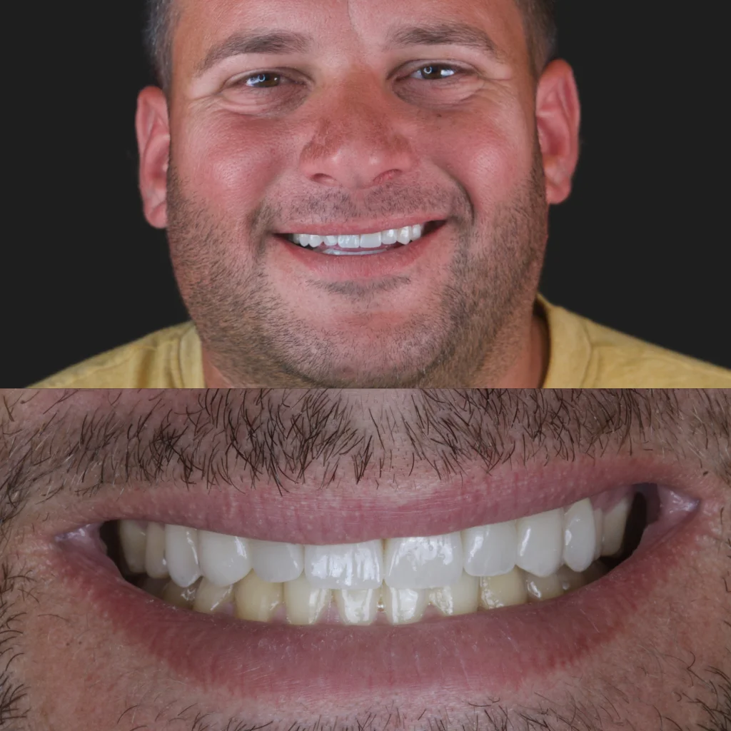 Carillas de Porcelana - José 2 Carillas de Porcelana - José 2