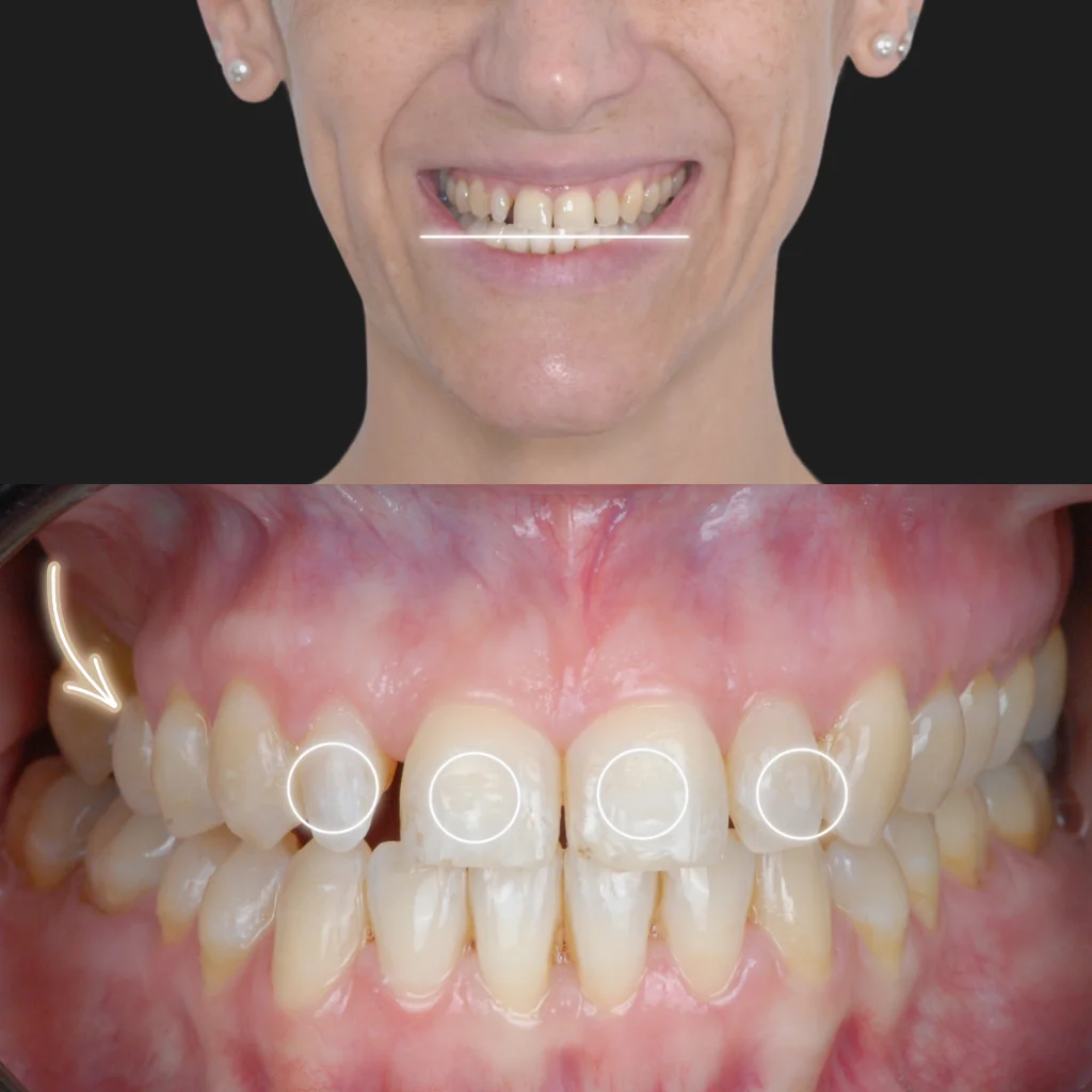 Carillas de Composite - Rocío 1 Carillas de Composite - Rocío 1